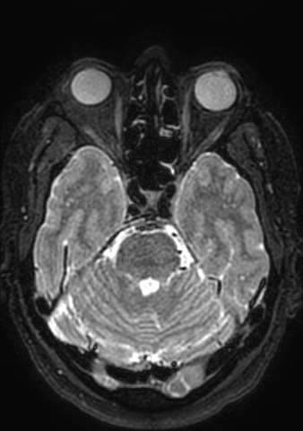File:Accessory middle cerebral artery (Radiopaedia 73114-83828 Axial T2 143).jpg