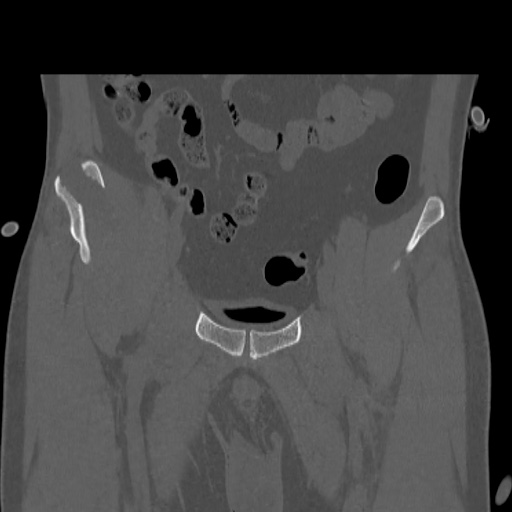 Acetabular and ilial fractures (Radiopaedia 59084-66378 Coronal bone window 13).jpg