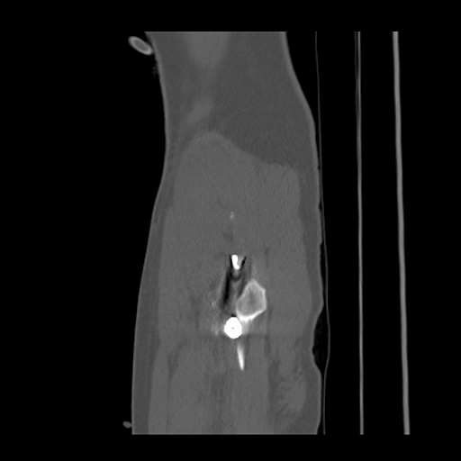 Acetabular and ilial fractures (Radiopaedia 59084-66378 Sagittal bone window 97).jpg