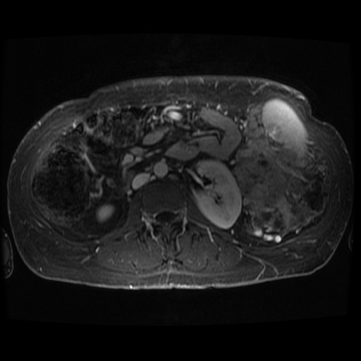 Acinar cell carcinoma of the pancreas (Radiopaedia 75442-86668 D 20).jpg