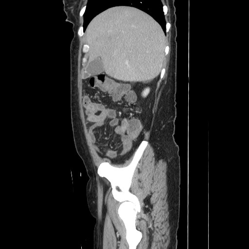 Acinar cell carcinoma of the pancreas (Radiopaedia 75442-86669 Sagittal C+ portal venous phase 51).jpg