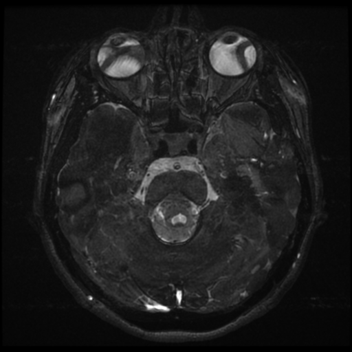 Acoustic neuroma (Radiopaedia 34049-35283 Axial 81).png