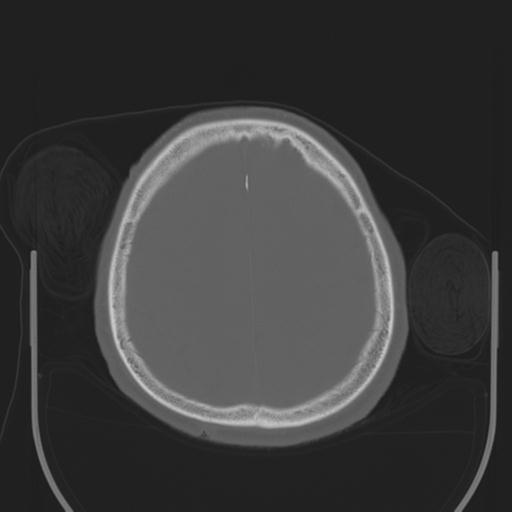 File:Acoustic schwannoma (Radiopaedia 29488-29982 AXIAL BONE THICK non-contrast 39).jpg