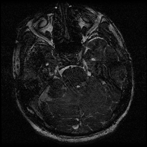 File:Acoustic schwannoma (Radiopaedia 39170-41387 Axial FIESTA 88).png