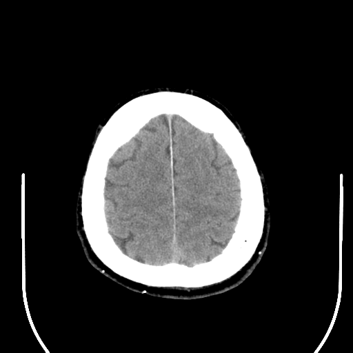 File:Acoustic schwannoma (Radiopaedia 39170-41388 Axial non-contrast 42).png
