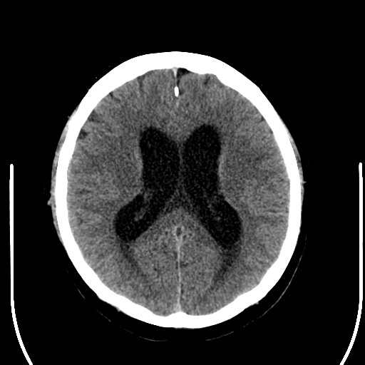 File:Acoustic schwannoma (Radiopaedia 39170-41389 Axial non-contrast 17).png