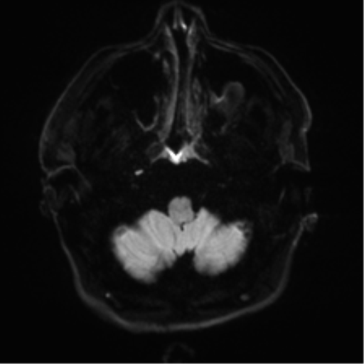 File:Acoustic schwannoma (Radiopaedia 50846-56358 Axial DWI 30).png