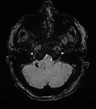 Acoustic schwannoma (Radiopaedia 50846-56358 Axial SWI 16).png