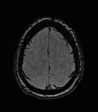 Acoustic schwannoma (Radiopaedia 50846-56358 Axial SWI 79).png