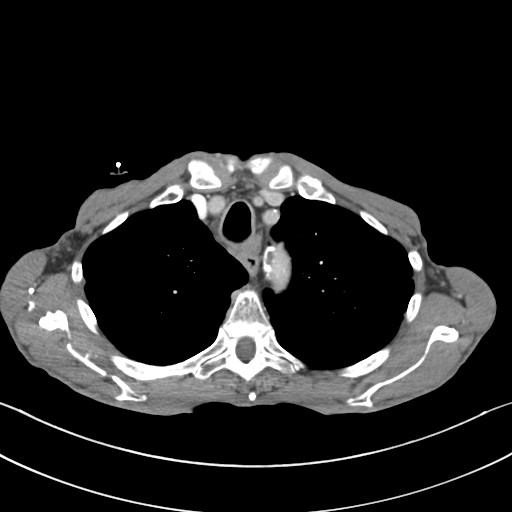 File:Acquired tracheoesophageal fistula (Radiopaedia 57747-65042 Axial C+ portal venous phase 21).jpg