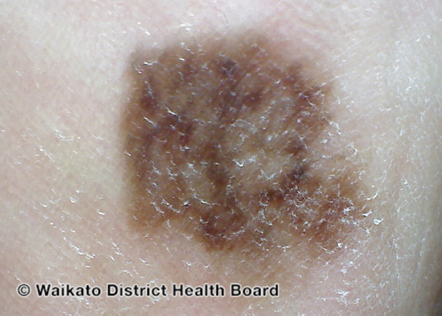 File:Acral lentiginous melanoma 4 macro (DermNet NZ alm-4-macro).jpg