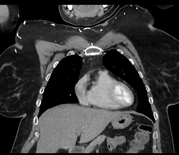 Acromioclavicular joint cyst (Radiopaedia 58455-65610 Coronal C+ arterial phase 50).jpg