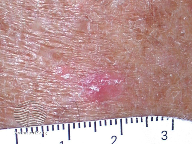 Actinic Keratoses affecting the face (DermNet NZ lesions-ak-face-535).jpg