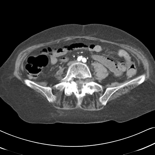 File:Active bleeding from duodenal ulcer with embolization (Radiopaedia 34216-35481 Axial C+ arterial phase 40).png
