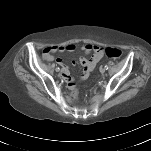 File:Active bleeding from duodenal ulcer with embolization (Radiopaedia 34216-35481 Axial non-contrast 53).png