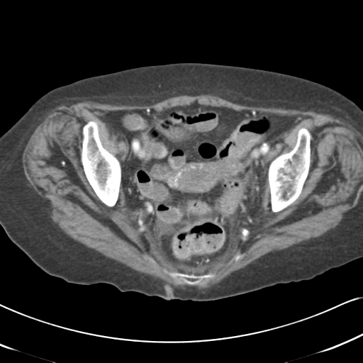 File:Active bleeding from duodenal ulcer with embolization (Radiopaedia 34216-35481 C 57).png