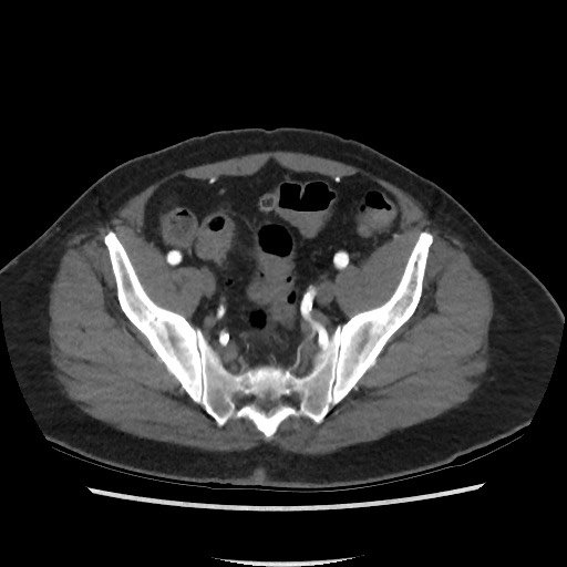 Active colonic bleed on CT (Radiopaedia 49765-55025 Axial C+ arterial phase 67).jpg