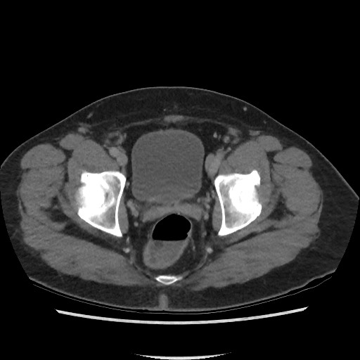 File:Active colonic bleed on CT (Radiopaedia 49765-55025 Axial C+ delayed 76).jpg