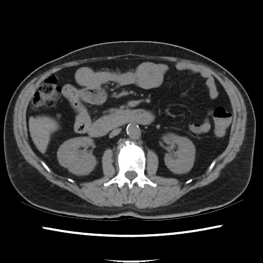 Active colonic bleed on CT (Radiopaedia 49765-55025 Axial non-contrast 34).jpg