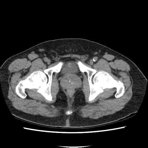 Active colonic bleed on CT (Radiopaedia 49765-55025 Axial non-contrast 82).jpg