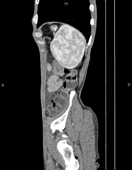 Active crohn disease (Radiopaedia 87133-103397 Sagittal C+ arterial phase 79).jpg