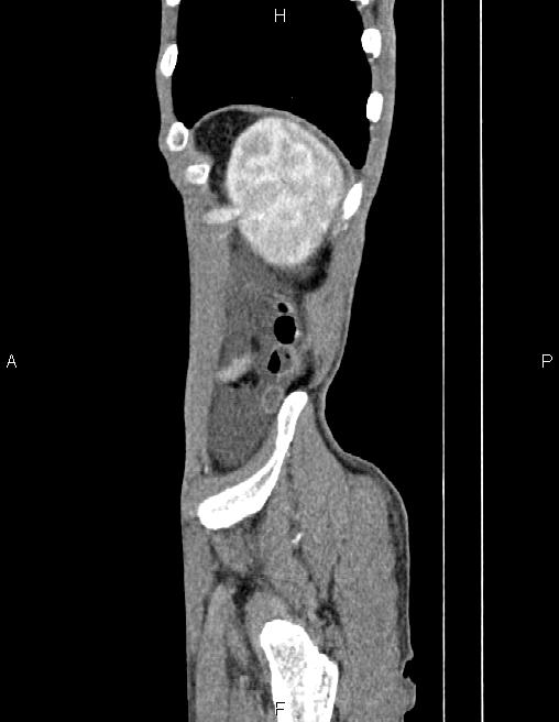Active crohn disease (Radiopaedia 87133-103397 Sagittal C+ arterial phase 82).jpg