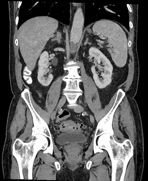 Active lower gastrointestinal bleeding - diverticular (Radiopaedia 61203-69106 Coronal C+ portal venous phase 82).jpg