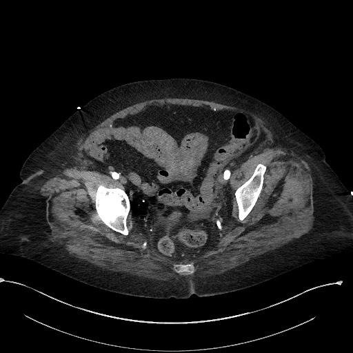 Active renal extravasation with large subcapsular and retroperitoneal hemorrhage (Radiopaedia 60975-68796 Axial C+ arterial phase 171).jpg