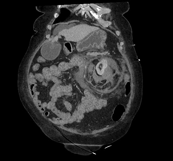 Active renal extravasation with large subcapsular and retroperitoneal hemorrhage (Radiopaedia 60975-68796 Coronal C+ portal venous phase 45).jpg