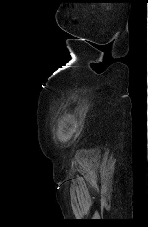 Active renal extravasation with large subcapsular and retroperitoneal hemorrhage (Radiopaedia 60975-68796 Sagittal C+ portal venous phase 36).jpg
