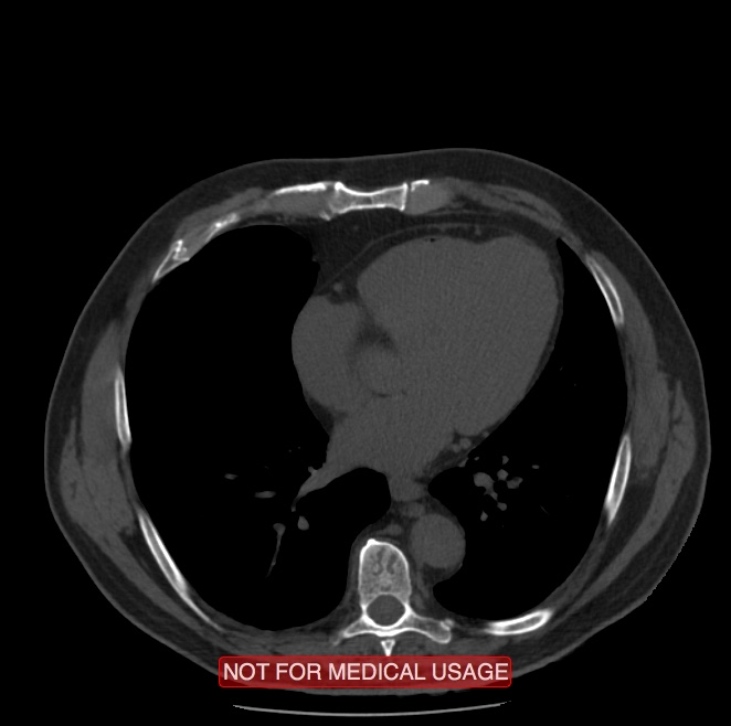 Acute aortic dissection - Stanford type A (Radiopaedia 40661-43285 Axial non-contrast 41).jpg