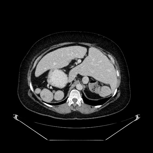 Acute appendicitis, heterotaxy syndrome (Radiopaedia 66884-76202 Axial C+ portal venous phase 35).jpg