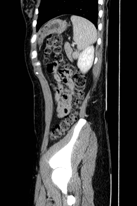 Acute appendicitis (Radiopaedia 22892-22918 Sagittal C+ portal venous phase 72).png