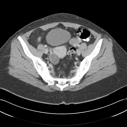 File:Acute appendicitis (Radiopaedia 30297-30934 Axial C+ portal venous phase 66).jpg