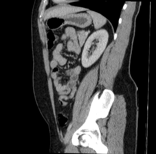 Acute appendicitis (Radiopaedia 38255-40270 Sagittal C+ portal venous phase 58).jpg