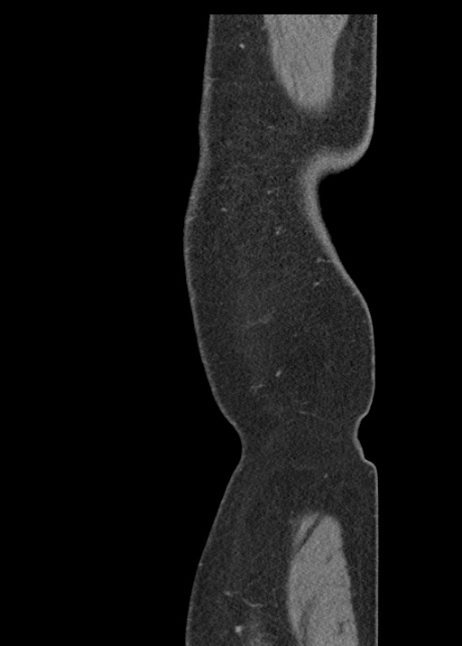 Acute appendicitis (Radiopaedia 48511-53463 Sagittal C+ portal venous phase 130).jpg