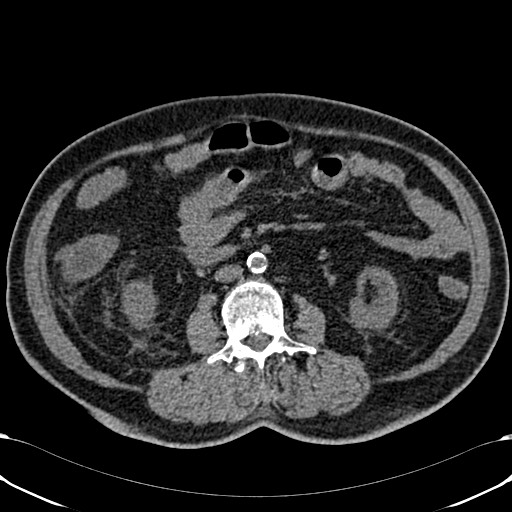 File:Acute appendicitis (Radiopaedia 58627-65818 Axial non-contrast 45).jpg