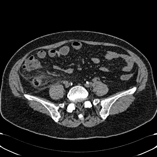 Acute appendicitis (Radiopaedia 58627-65818 Axial non-contrast 59).jpg