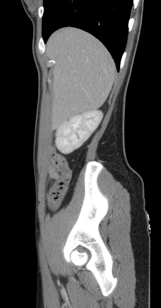 Acute appendicitis (Radiopaedia 62608-70901 Sagittal C+ portal venous phase 50).jpg