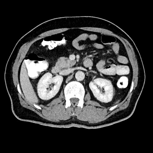 Acute appendicitis (Radiopaedia 77016-88960 Axial C+ portal venous phase 55).jpg