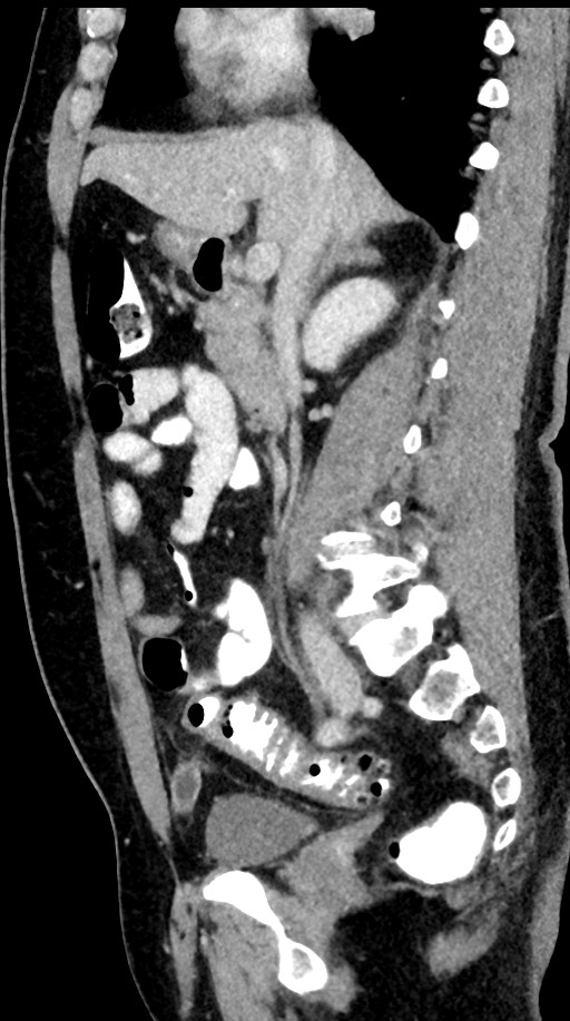 Acute appendicitis (Radiopaedia 77016-88960 Sagittal C+ portal venous phase 68).jpg