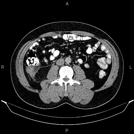 Acute appendicitis (Radiopaedia 84780-100240 Axial C+ portal venous phase 55).jpg