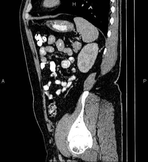 Acute appendicitis (Radiopaedia 84780-100240 Sagittal C+ portal venous phase 82).jpg