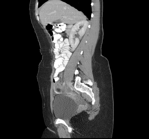 File:Acute appendicitis (Radiopaedia 9417-10099 Sagittal C+ portal venous phase 9).jpg