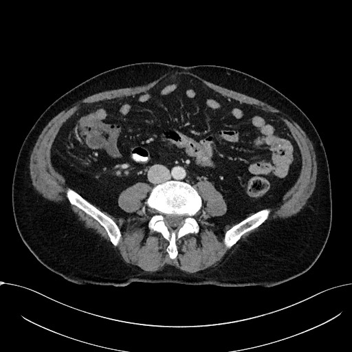 Acute appendicitis - large appendicoliths (Radiopaedia 61805-69820 Axial C+ portal venous phase 76).jpg