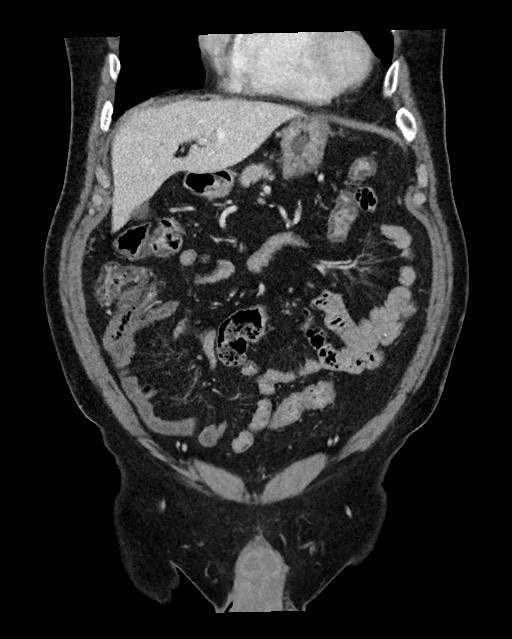 Acute appendicitis - large appendicoliths (Radiopaedia 61805-69820 Coronal C+ portal venous phase 41).jpg