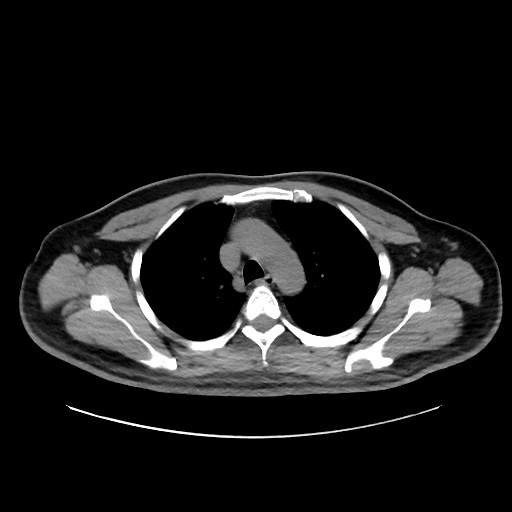 Acute appendicitis and COVID 19 pneumonia (Radiopaedia 76604-88380 Axial non-contrast 17).jpg