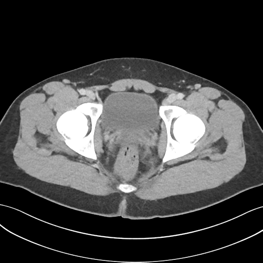 File:Acute appendicitis with appendicoliths (Radiopaedia 50186-55532 Axial C+ portal venous phase 79).png