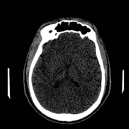 Acute basilar artery occlusion (Radiopaedia 43582-46985 Axial non-contrast 101).jpg