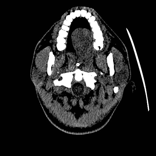Acute basilar artery occlusion (Radiopaedia 43582-46985 Axial non-contrast 16).jpg